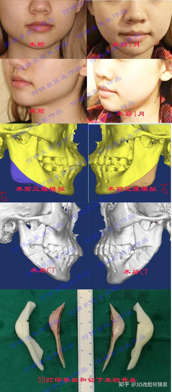 1 手术行ct扫描检查,重建下颌骨的三维模型