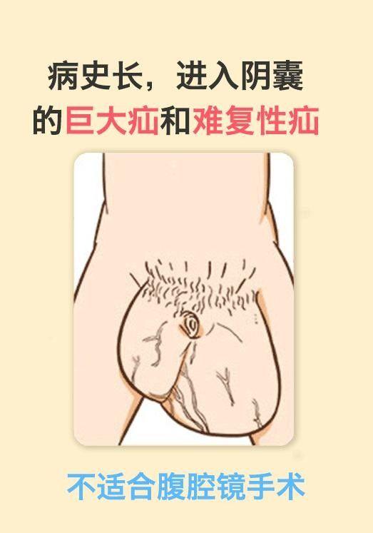 腹股沟酸痛是疝气吗?