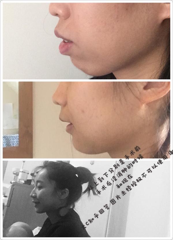 正颌手术风险大吗,过程是怎样的?