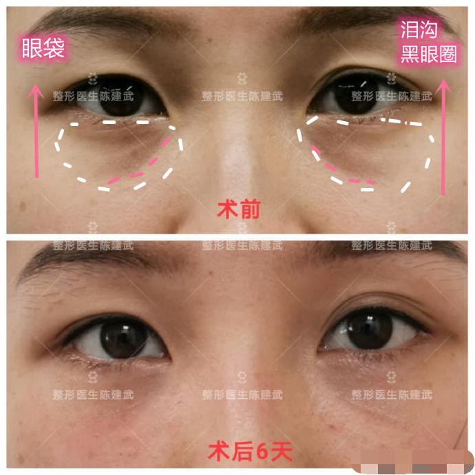 25岁美女做完眼袋手术后,泪沟不见了,黑眼圈也改善了