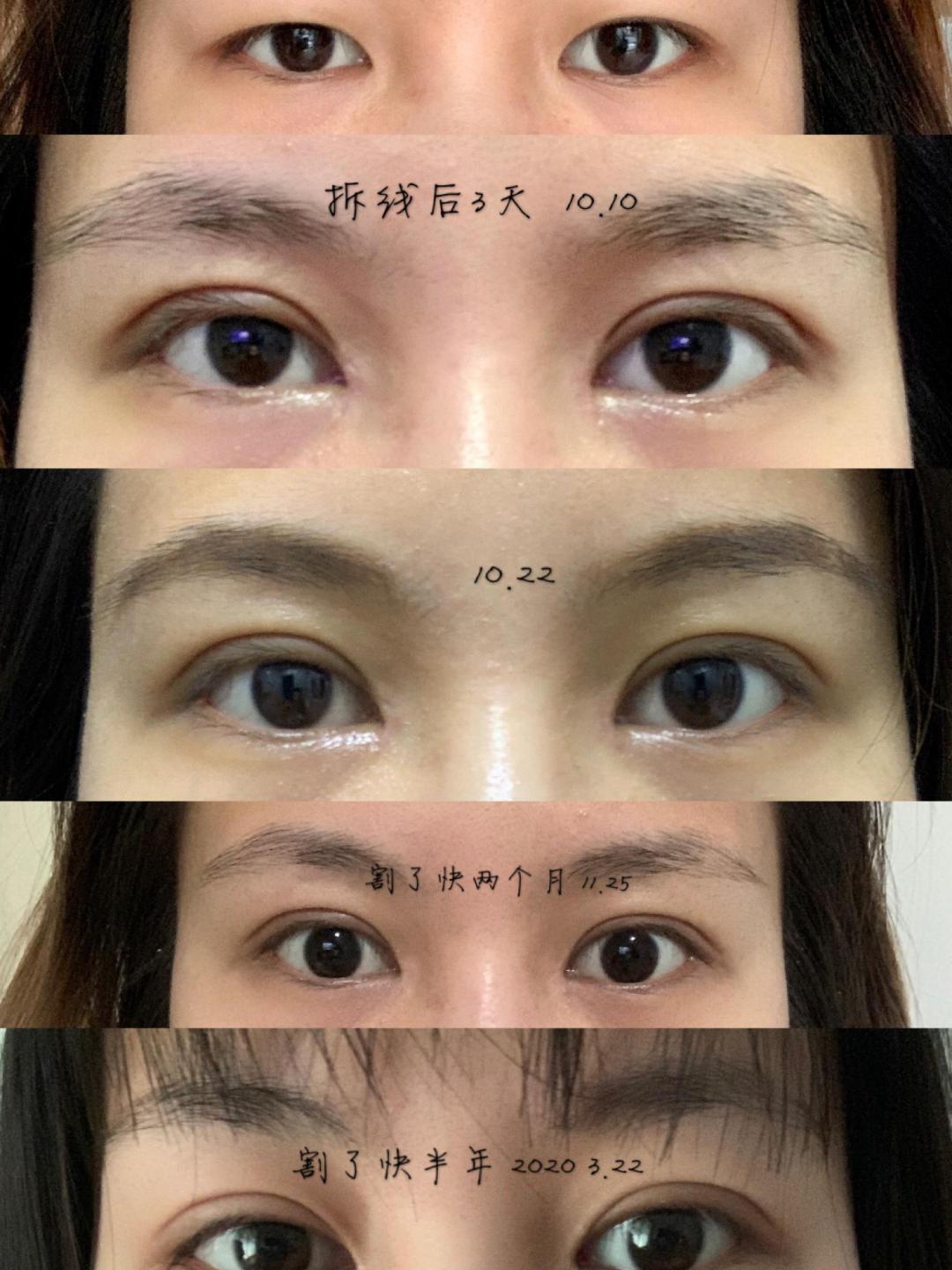 超详细的广州割双眼皮的恢复记录案例医生分享