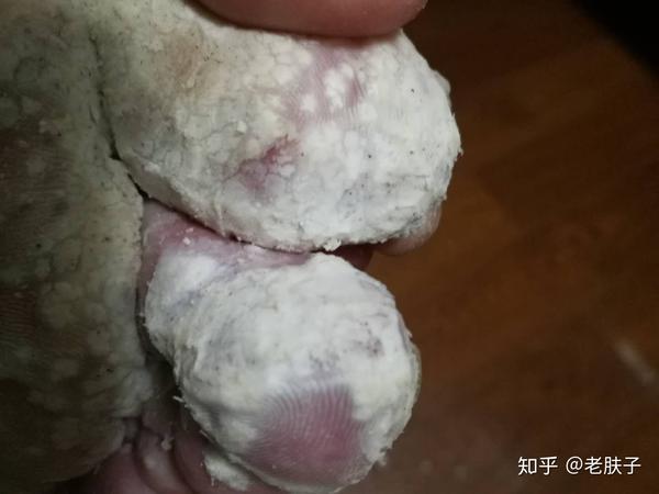 脚底大面积跖疣去除恢复过程图{慎点}