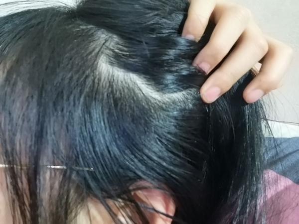 记录一下脂溢性脱发女生用米诺地尔的过程