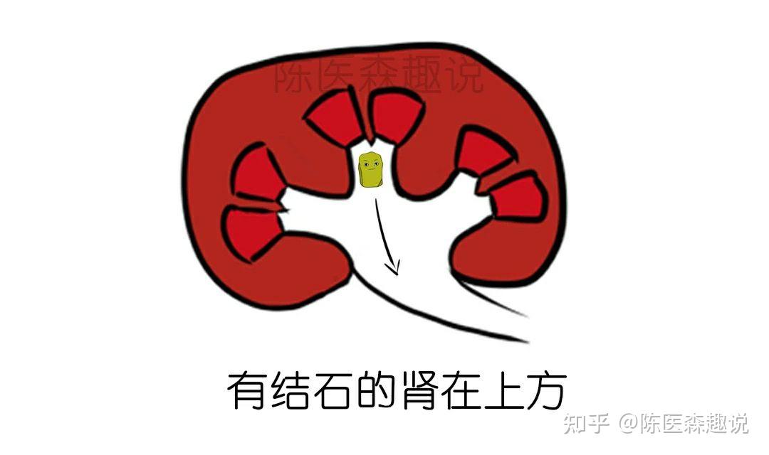 倒立排出肾结石是什么原理