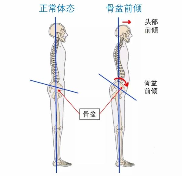 骨盆前倾你该怎么办呢