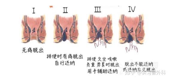 痔疮如何少受苦早康复免开刀