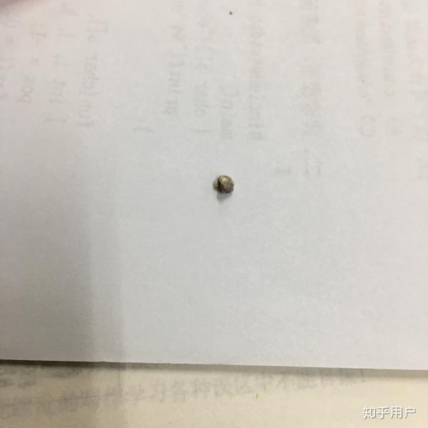 肾结石能完全排出吗?