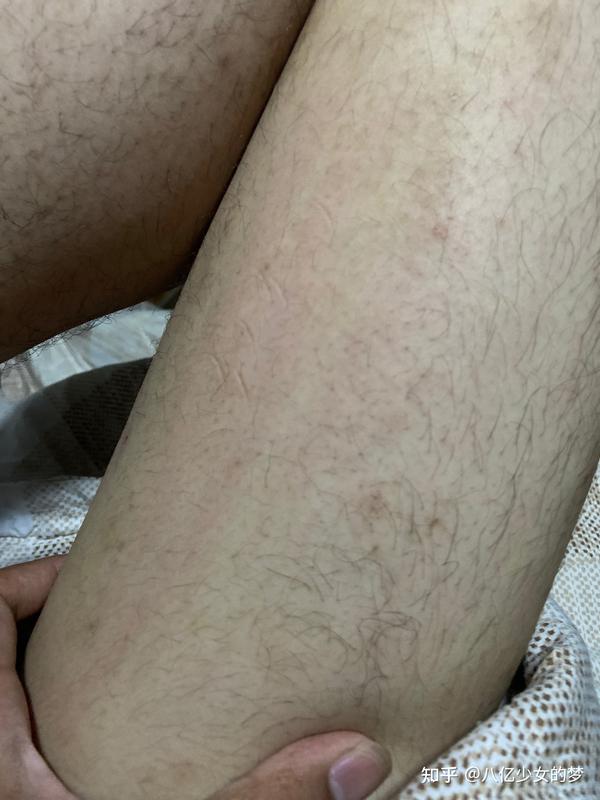 新冠疫苗过敏症状