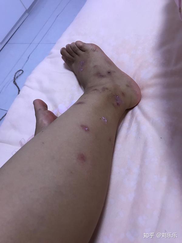 被跳蚤咬过的腿