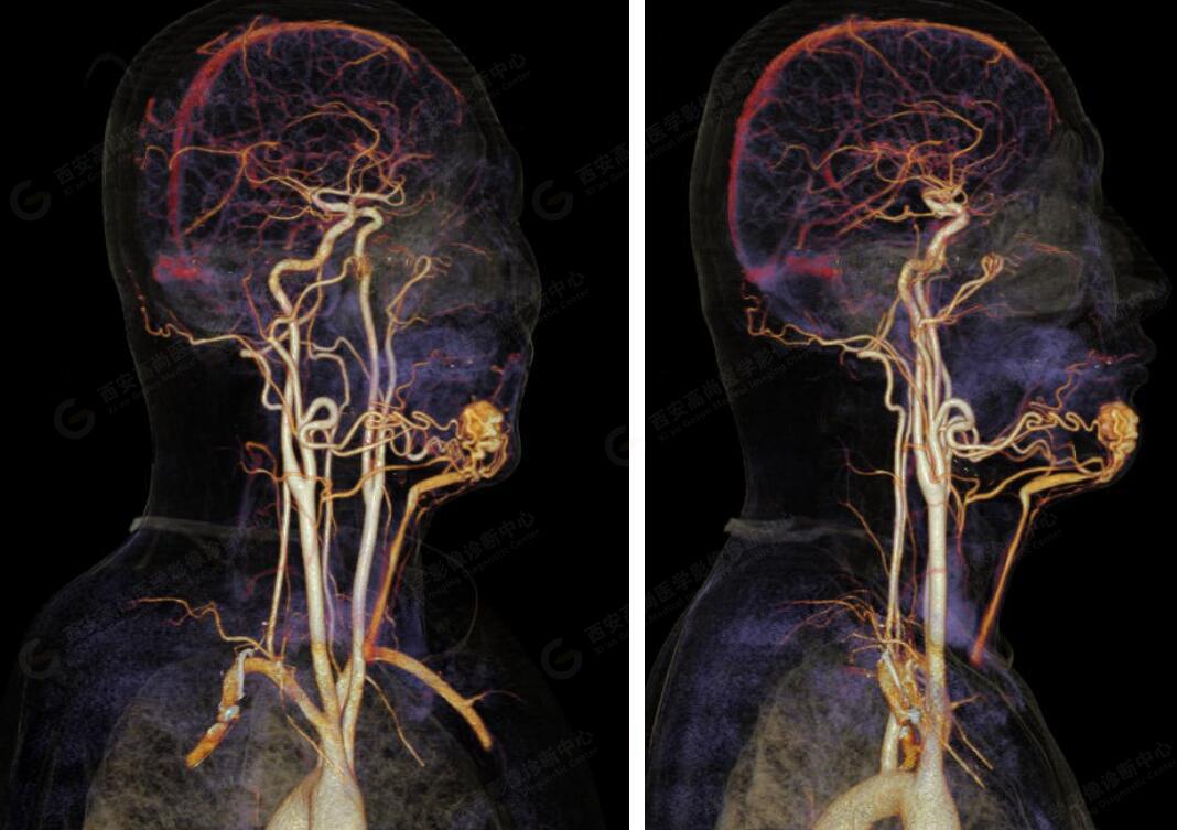 西安高尚病例颌面部血管畸形ctactv成像技术应用