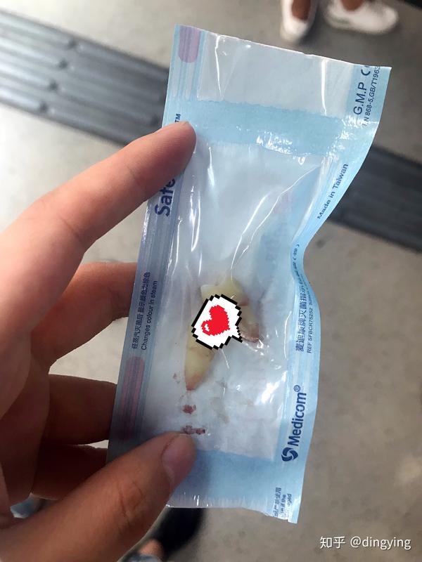 拔牙,9月份,拔了两颗矫正牙