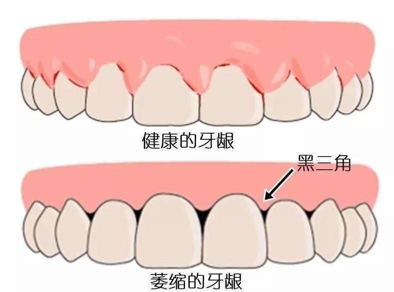 牙齿黑三角是怎么来的?有黑三角要如何解决?