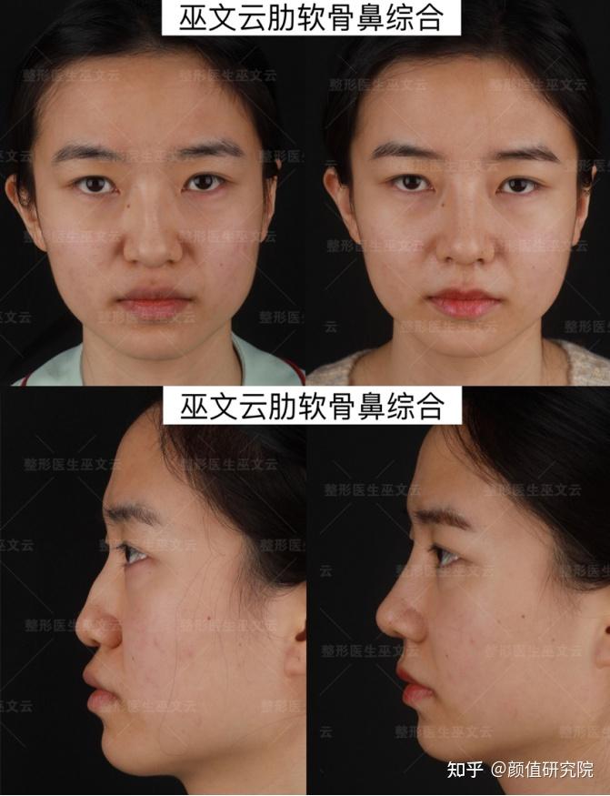 北京隆鼻哪里好巫文云刘彦军李劲良怎么样