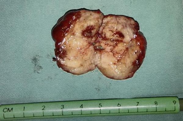 ct检查一定百分百准确吗一例胃间质瘤误诊为左肾上腺肿瘤