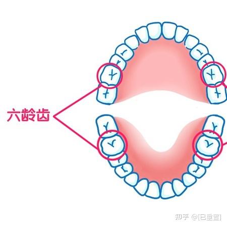 门头沟儿童口腔:儿童"六龄齿"龋坏可致终身缺牙