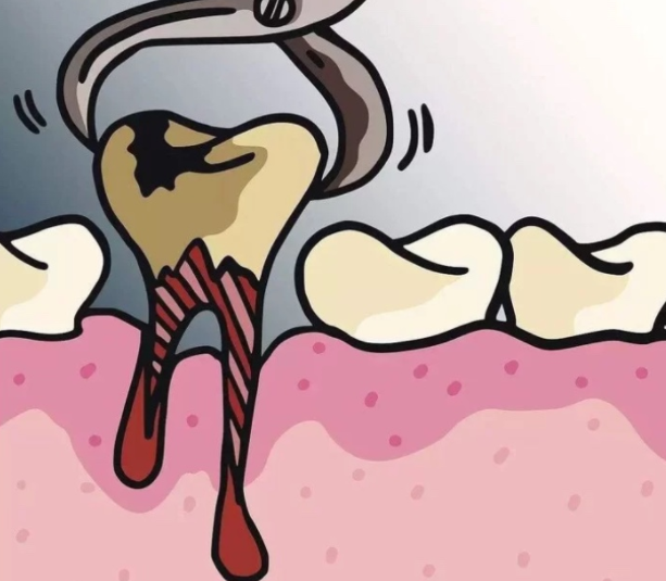 拔牙没拔干净牙洞会愈合吗不但不会愈合还可能造成细菌感染