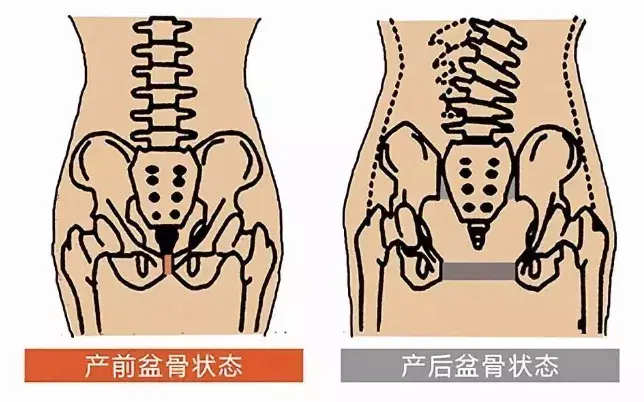 产后骨盆修复为什么很重要?看完这篇你就知道了!