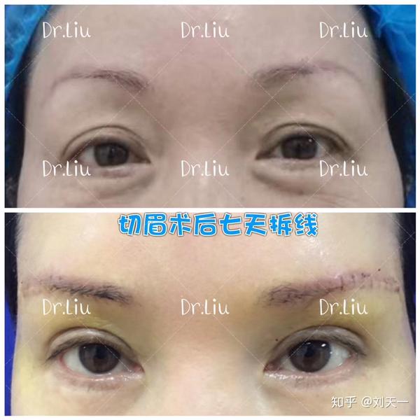 (图二)提眉术后七天 图片介绍: (图一)切眉的两种方法:眉上切口&眉下