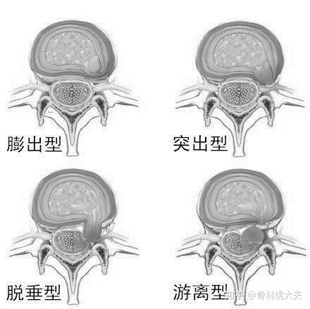 脊椎突出图片图片