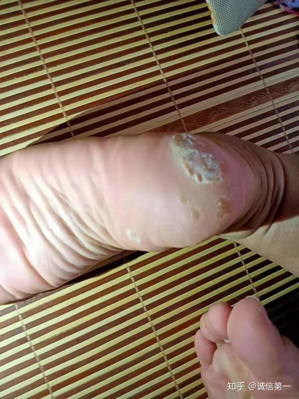 跎疣必须要冷冻吗