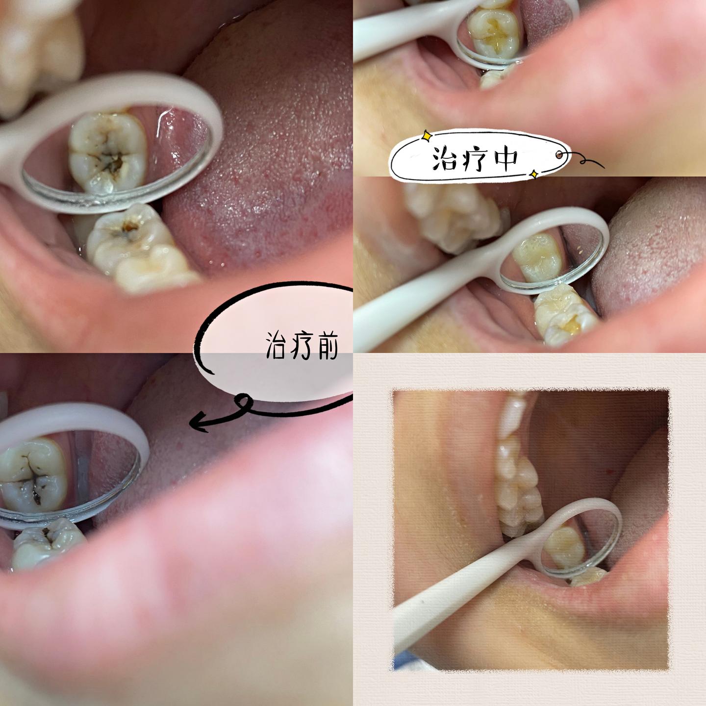 合肥蛀牙修复多少钱一颗-龋坏发黑牙树脂补牙案例分享