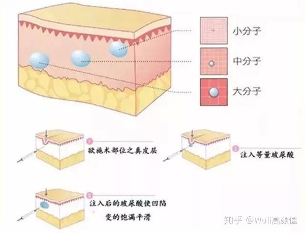 玻尿酸与水光针的用处