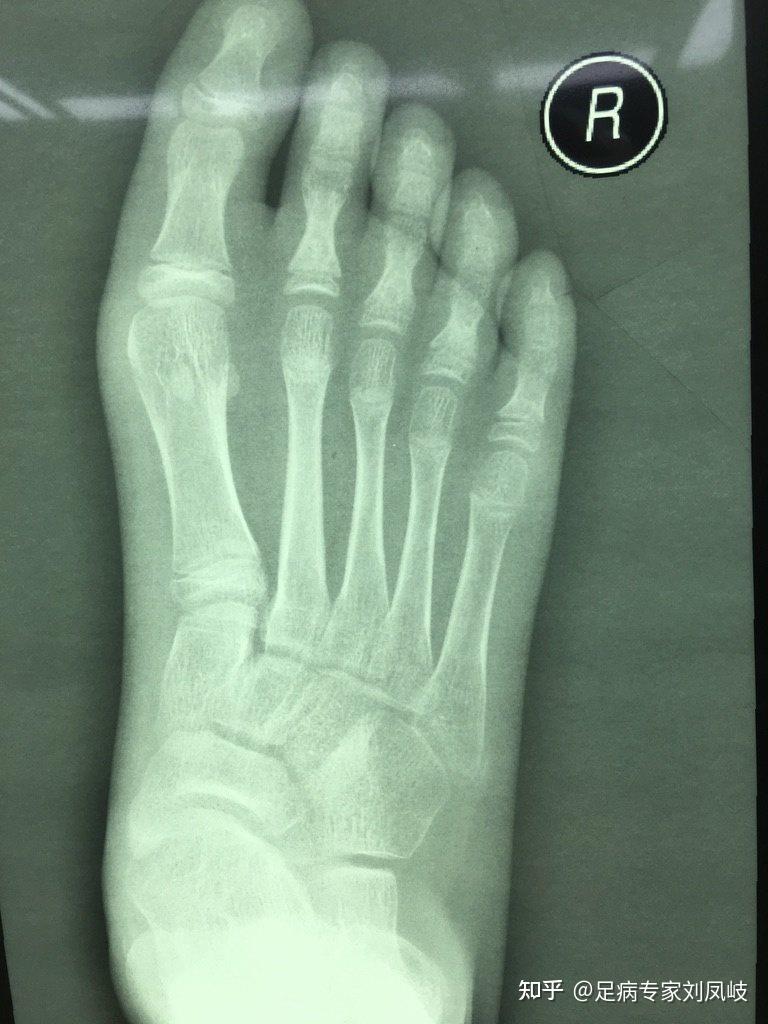 儿童脚疼的常见原因却被经常漏诊的问题北京和平里中西医结合医院骨科