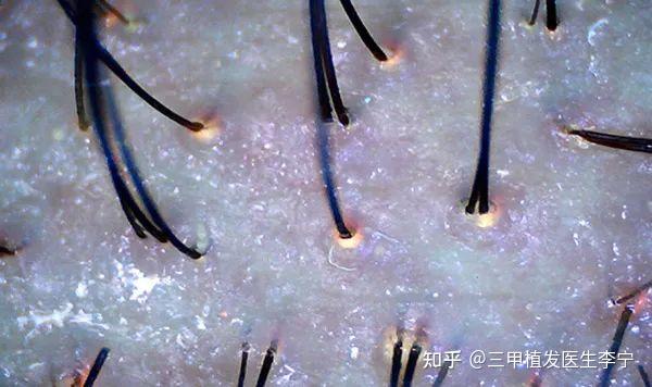 头皮毛囊 知乎