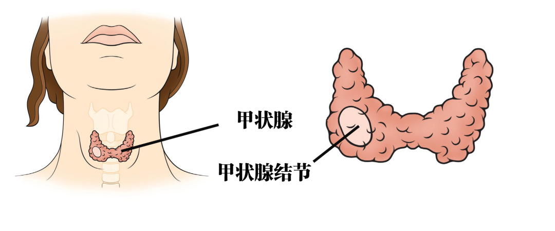 已认证的官方帐号 正常人担心吃碘过多会有甲状腺结节;甲状腺结节的人