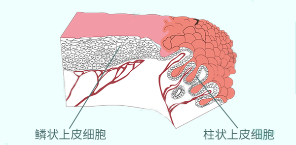 受雌性激素影响,其位置会出现变化,不同年龄段女性宫颈柱状上皮细胞受