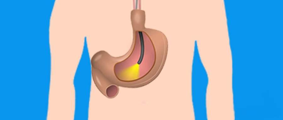 胃镜检查,进来了解一下?