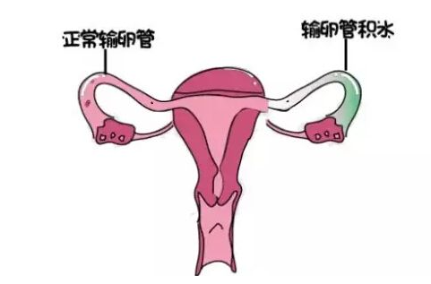 输卵管积水有什么症状是什么原因导致的输卵管积水