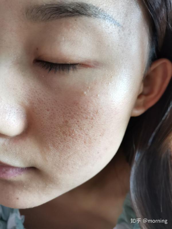 点阵激光去毛孔痘坑记录