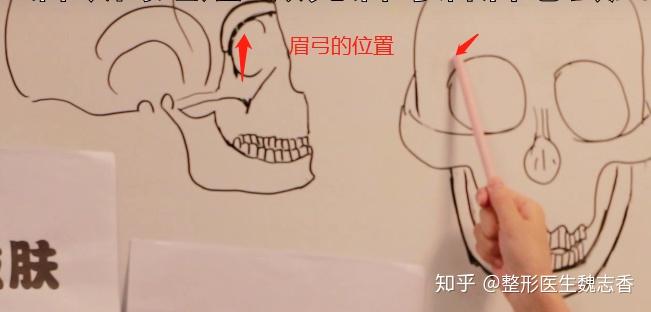 眉眼间距短做完眉弓后会眉压眼吗