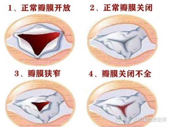 瓣膜在心脏永不停止的血液循环活动中扮演关键角色:瓣膜相当于门卫