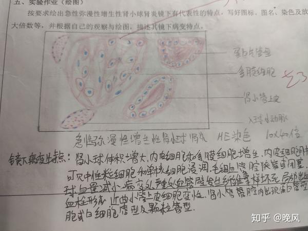 学渣字丑,图画的丑,将就一下. 1.肝脂肪变性