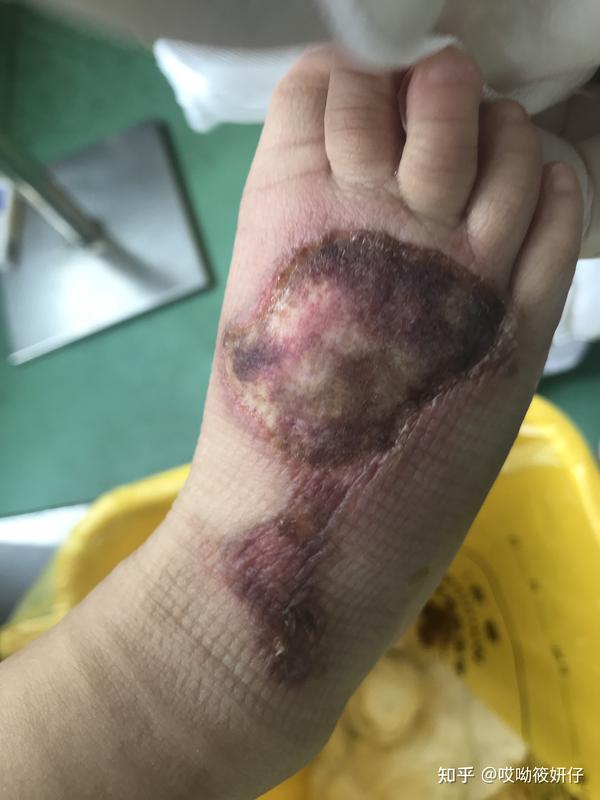 一岁半宝宝深二度浅二度烫伤