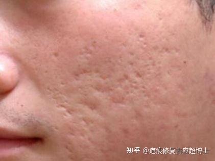 脸上好多痘坑怎么办