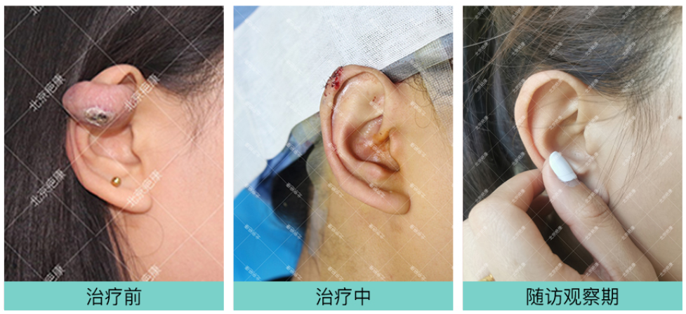 4 治疗详情: 山东25岁的王女士,因打耳洞导致耳朵凸起疤痕疙瘩,自觉