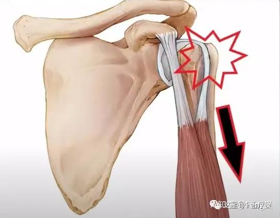 【运动损伤respond】第六期 |肩关节-肱二头肌长头肌腱炎