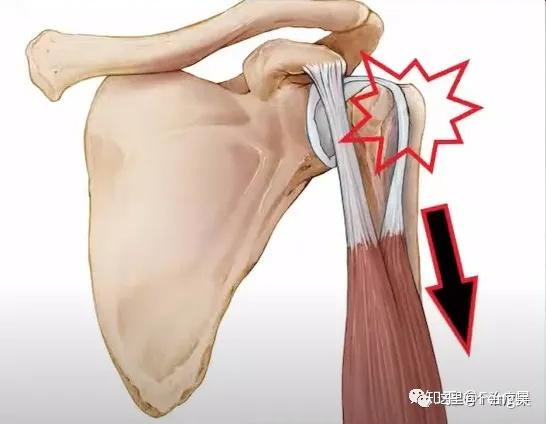 运动损伤respond第六期肩关节肱二头肌长头肌腱炎
