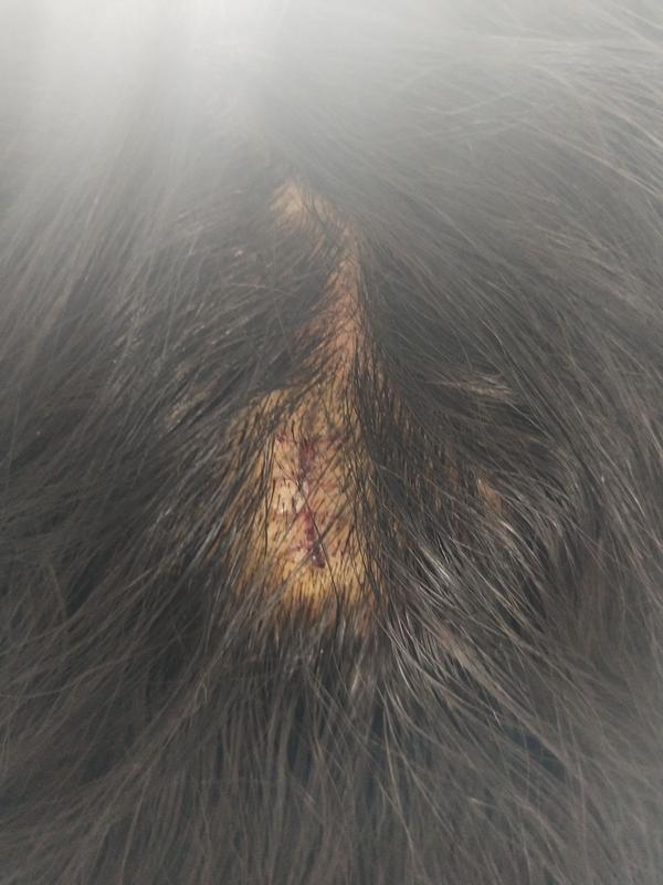 头部瘊子(寻常疣)的切除手术