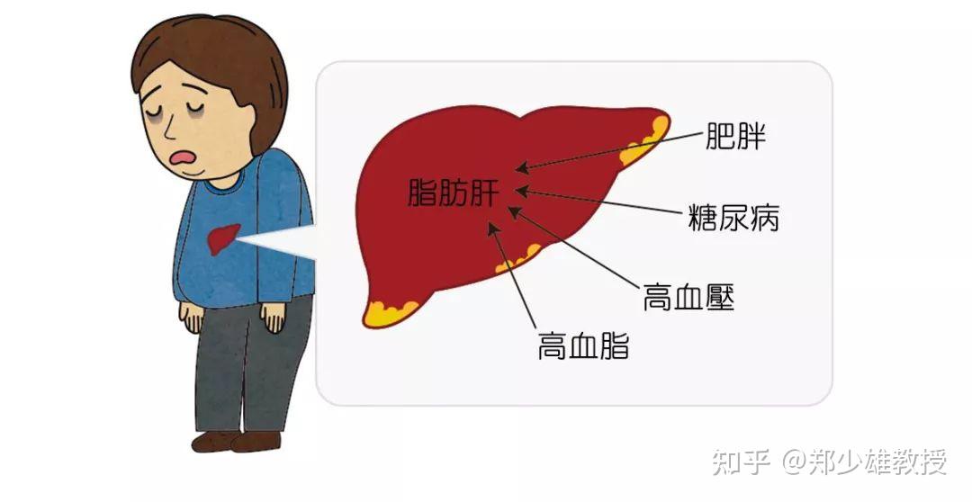 尤其是脂肪肝,如果不能得到有效防治,不少患者终将发生肝硬化和肝癌.