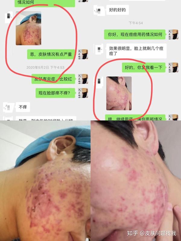 湿疹治疗12年的经验汇总,湿疹的注意事项,全部湿疹真实案例反馈