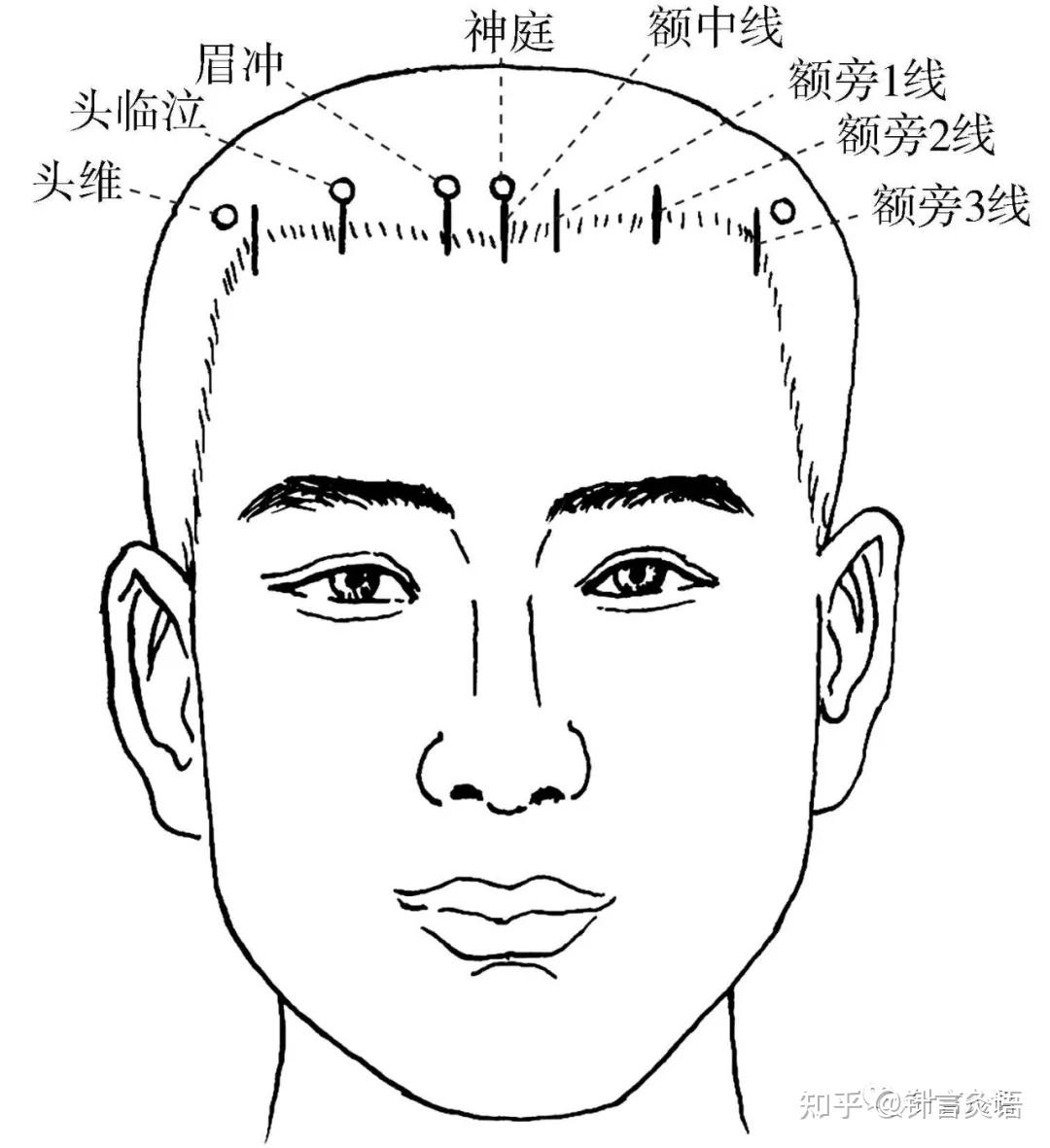 焦顺发头针疗效如何