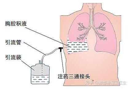 抽胸水是怎么一回事