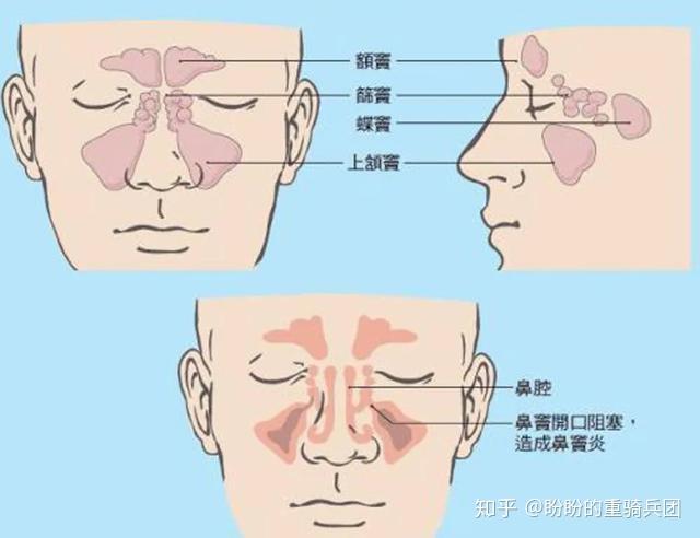 位于上筛骨迷路内,又分前,中,后筛窦.