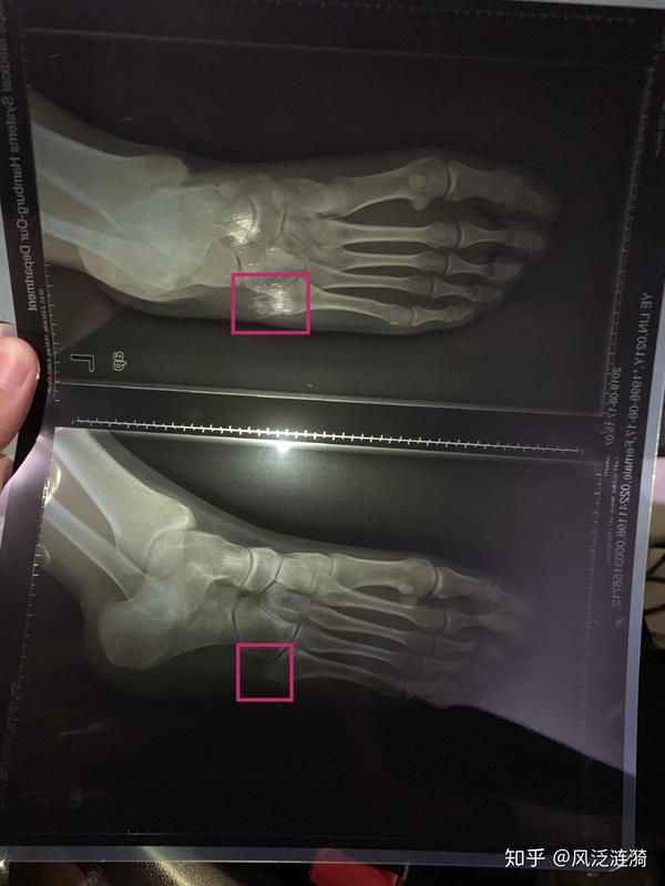 第五跖骨基底部骨折三个月复查结束可以到处蹦了