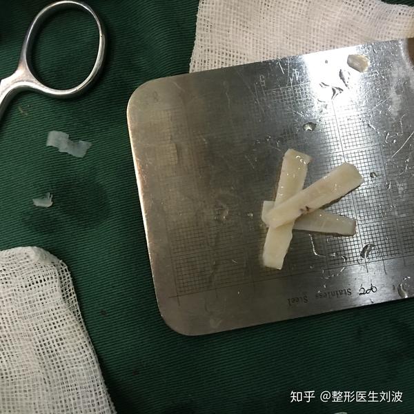 肋软骨隆鼻鼻尖支架是用薄薄的片状肋软骨搭建的,简单的示意如下图.