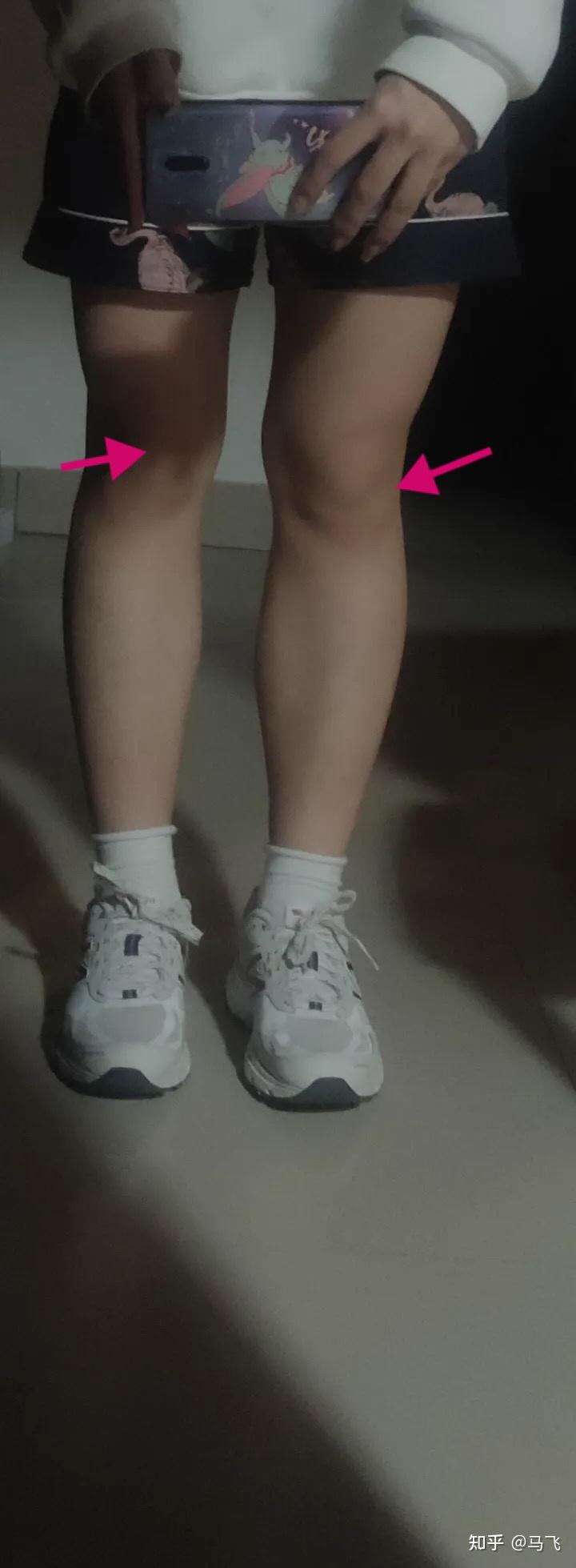 这是肌肉腿还是脂包肌还是肥肉呀